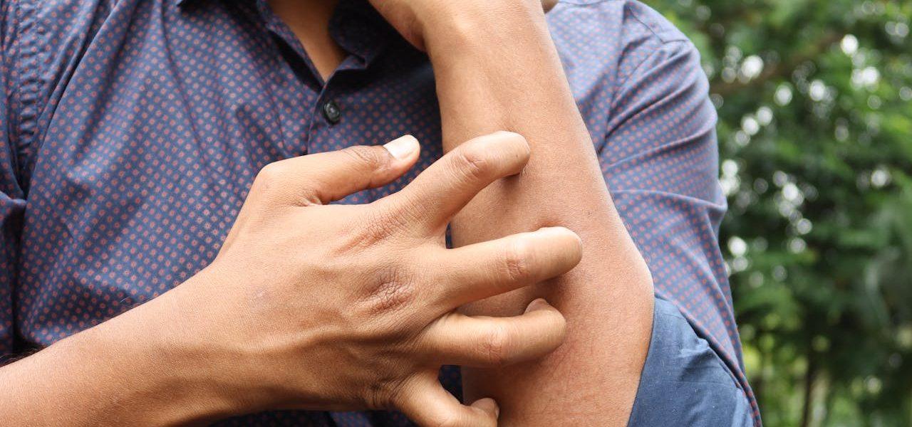 Dupixent Now Approved for Chronic Spontaneous Urticaria